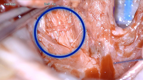 palatoplasty Nervous
